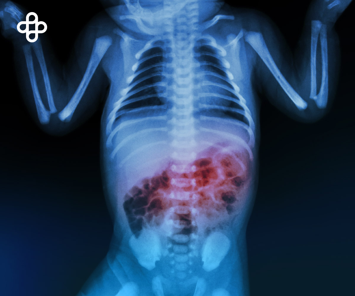 Treatment of Necrotizing Enterocolitis (NEC)