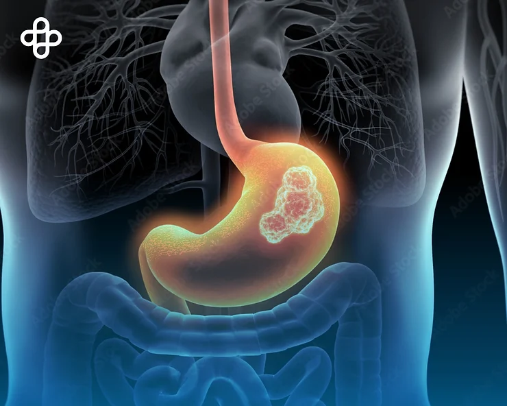 Prevent Gastritis: Symptoms and Useful Tips.