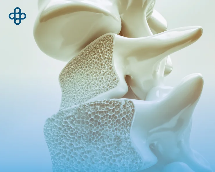 Understanding Osteoporosis: Causes